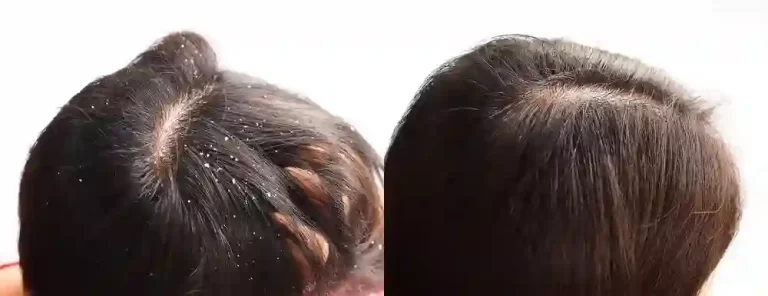 How To Prevent Dandruff And Hair Fall