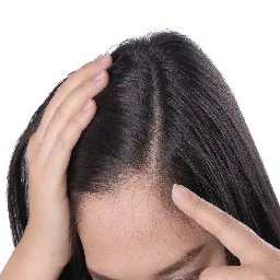 Top 10 Causes of Dandruff and How to Address Them