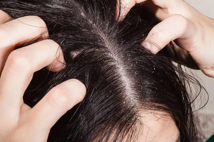 Causes of Dandruff